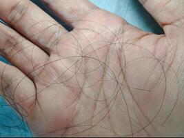 a person's hand with hair loss on it photo