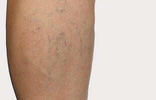 telangiectasia and spider veins on the leg. isolated on white background. free space for your text photo