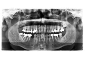 X ray of teeth photo