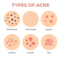 Acne types. Skin infection problem, pimples grade and type cyst, whitehead, blackheads, nodule and cystic. Dermis pore disease vector set