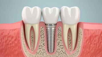 AI generated Explore the intricacies of dental implantology with a cross-section of the jaw showcasing an embedded implant in the gum. Ai Generated photo