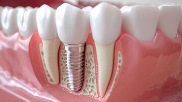 AI generated Explore the intricacies of dental implantology with a cross-section of the jaw showcasing an embedded implant in the gum. Ai Generated photo