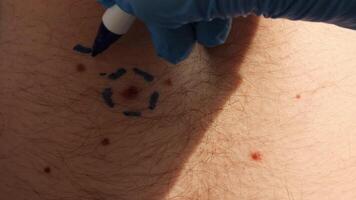 medico nel medico guanti dipingere Linee in giro maschio voglie. preparazione procedura per medico chirurgia. laser pelle tag rimozione. prevenzione di melanoma e nevo esame video