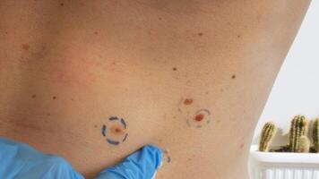 Dermatologist apply skin cream on male birthmarks. Checking benign moles. Presentation of skin cancer procedure. Doctor checking skin tags on man video
