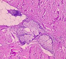 Lipoma on loin, benign growth of fatty tissue, benign neoplasm, adipocytes, partially capsulated tumor, 40x microscopic view. photo