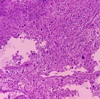 Thyroid cancer. Microscopic image of Follicular neoplasm. Malignant neoplasm of atypical thyroid follicular epithelial cells. Some of cells show pleomorphism with nuclear grooving. Nodular goiter. photo