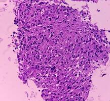 Thyroid cancer. Microscopic image of Follicular neoplasm. Malignant neoplasm of atypical thyroid follicular epithelial cells. Some of cells show pleomorphism with nuclear grooving. Nodular goiter. photo