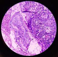 íleo-cecal úlcera. crónico no específico ileítis con úlcera. sección espectáculo ileal mucosa, denso infiltración de linfocitos, histiocitos, plasma célula en lámina propio. ibd. foto