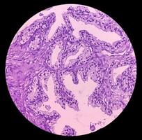 Prostatic Tissue biopsy. Sections show show fatty tissue, neural tissue and muscle tissue. Prostate cancer diagnosis. photo