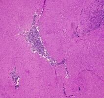 Thyroid cancer. Microscopic image of Follicular neoplasm. Malignant neoplasm of atypical thyroid follicular epithelial cells. Some of cells show pleomorphism with nuclear grooving. Nodular goiter. photo