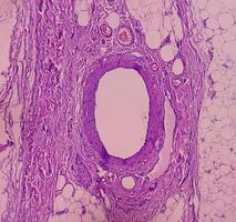 lipoma en lomo, benigno crecimiento de graso tejido, benigno neoplasma, adipocitos, parcialmente capsulado tumor, 40x microscópico vista. foto