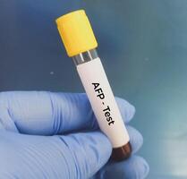 Blood sample for Alpha-fetoprotein or AFP testing, tumor or cancer marker test for liver. photo