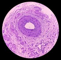 Prostatic Tissue biopsy. Sections show show fatty tissue, neural tissue and muscle tissue. Prostate cancer diagnosis. photo