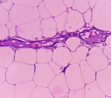 Lipoma on cubital fossa, benign growth of fatty tissue, benign neoplasm, adipocytes, partially capsulated tumor, 40x microscopic view. photo