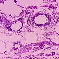 Lipoma on loin, benign growth of fatty tissue, benign neoplasm, adipocytes, partially capsulated tumor, 40x microscopic view. photo