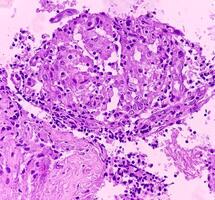 Thyroid cancer. Microscopic image of Follicular neoplasm. Malignant neoplasm of atypical thyroid follicular epithelial cells. Some of cells show pleomorphism with nuclear grooving. Nodular goiter. photo