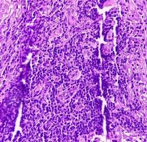 Thyroid cancer. Microscopic image of Follicular neoplasm. Malignant neoplasm of atypical thyroid follicular epithelial cells. Some of cells show pleomorphism with nuclear grooving. Nodular goiter. photo