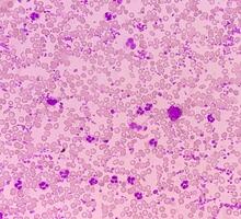 esencial trombocitosis sangre frotis demostración anormal alto volumen de plaqueta y blanco sangre células. panmielosis. mieloprociferante trastorno. foto