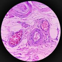 Lipoma on loin, benign growth of fatty tissue, benign neoplasm, adipocytes, partially capsulated tumor, 40x microscopic view. photo