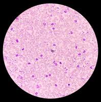 Essential thrombocytosis blood smear showing abnormal high volume of platelet and White Blood Cells. Panmyelosis. Myeloprokiferative disorder. photo