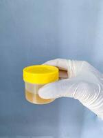 A urine sample is held in the hand of a man wearing white medical gloves photo