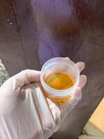 A urine sample is held in the hand of a man wearing white medical gloves photo