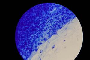 Mycobacterium tuberculosis appearance under the microscope is red with AFB staining photo