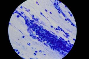 Mycobacterium tuberculosis appearance under the microscope is red with AFB staining photo