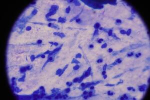 Mycobacterium tuberculosis appearance under the microscope is red with AFB staining photo