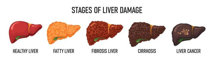 Stages of liver destruction vector