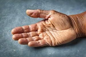 ai generado un antiguo hombre demostración su mano palma sufrimiento parkinson enfermedad foto