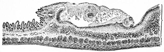 Section through a typhoid ulcer, vintage engraving. photo