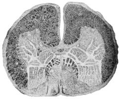 Spinal cord showing posterior sclerosis, vintage engraving. photo