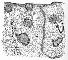 Section of lung showing chalicosis, vintage engraving. photo