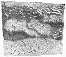 sección de cerebral corteza y meninges desde un caso de supurativo meningitis, Clásico grabado. foto