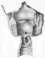 traqueal y parcial laríngeo estenosis siguiendo cicatrización de un goma, Clásico grabado. foto