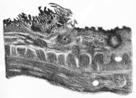 Margin of tubercular ulcer of the intestine, vintage engraving. photo