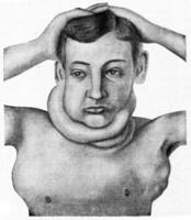 Hodgkin's disease, vintage engraving. photo