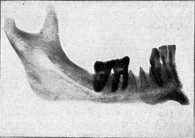 inferior humano cuerpo, en cuales el tercero molar tiene no alcanzado sus desarrollo, Clásico grabado. foto