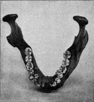 Lower jaw of an Australian with three premolars on each side and the location of an extra molar on the left half of the jaw, vintage engraving. photo