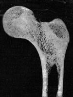 Longitudinal segment through the upper part of a human femur, vintage engraving. photo