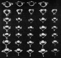 Comparative table of vertebral vertebrae of a European, two Australians, an African negro and a dwarf negro of the Philippines, vintage engraving. photo