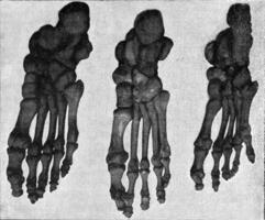 Comparative table of the skeleton of the foot of a Japanese, a European and an Australian, vintage engraving. photo