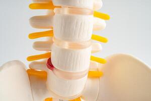 Lumbar spine displaced herniated disc fragment, spinal nerve and bone. Model for treatment medical in the orthopedic department. photo