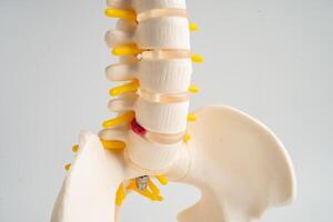 Lumbar spine displaced herniated disc fragment, spinal nerve and bone. Model for treatment medical in the orthopedic department. photo