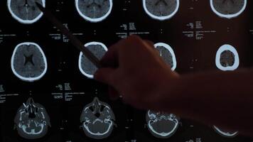 Magnetic resonance imaging of the brain from different sides, traumatic brain injury in an 60 old male patient in the hospital, showing that the brain is affected. Examination by a neurologist video