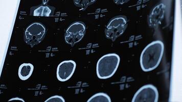 Magnetic resonance imaging of an older man's brain after a traumatic brain injury, which shows that the brain is damaged. Tomographic image of the head video