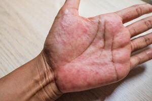 Red rash on the hands of the palms  ,and other infectious viral diseases in children and adults photo