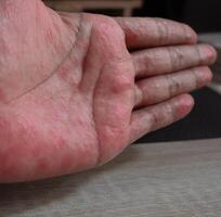 Hands with rash. Red sports on the hand, palm and fingers. photo