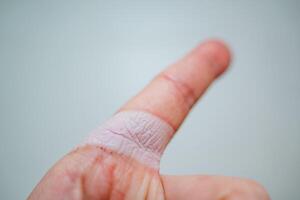 herida en el índice dedo. flácido piel en su brazo. el sitio de piel lesiones congelación de el dedo. foto